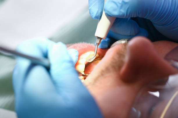 Best Emergency Dentist for Lost Fillings or Crowns in Charles City, IA