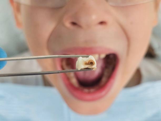 Best Emergency Root Canal Treatment in Charles City, IA