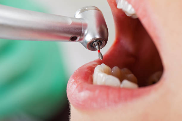Best Emergency Root Canal Treatment in Charles City, IA